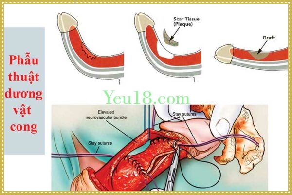 Phẫu thuật dương vật cong