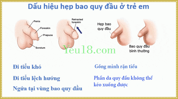 Việc nọng bao quy đầu cho bé là cần thiết để giúp bé trong sinh hoạt sau này