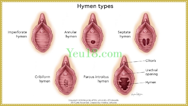 Hình dạng của màng trinh